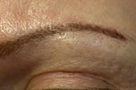 Micropicmintation After