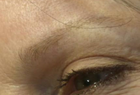 Micropicmintation After