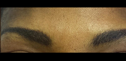 Micropicmintation Before