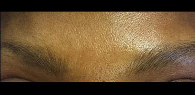 Micropicmintation Before