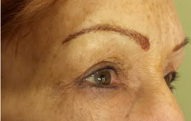 Micropicmintation Before