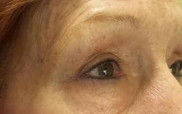 Micropicmintation Before