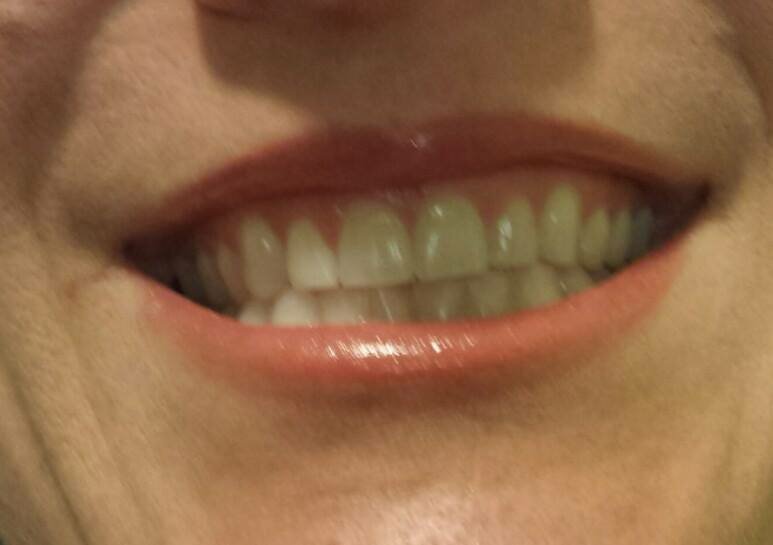 Teeth Whitening Before