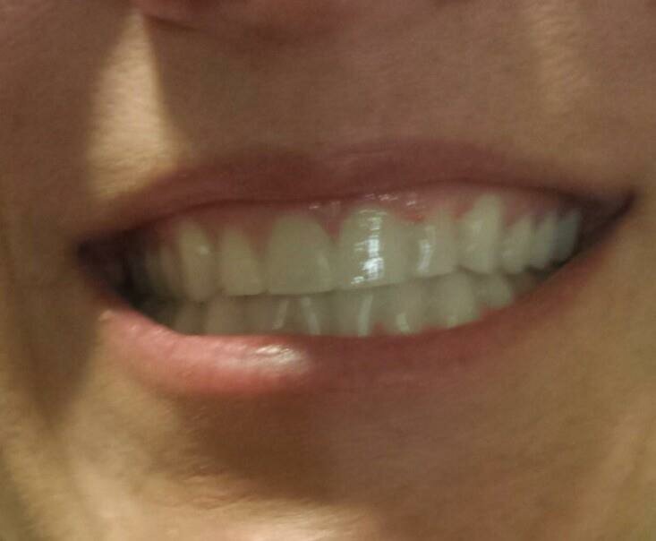 Teeth Whitening Before
