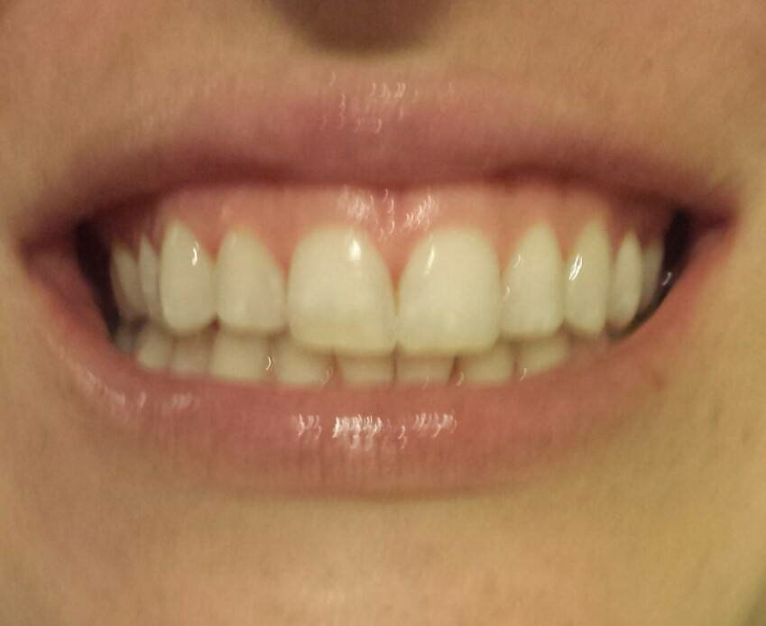 Teeth Whitening After