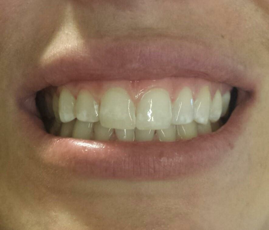 Teeth Whitening After